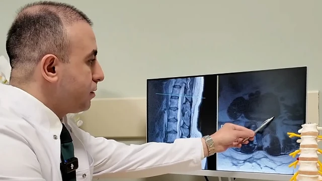 Bel Fıtığı Hakkında Bilmeniz Gerekenler ve Ameliyatın Sonuncu Çare Olduğu Uyarısı